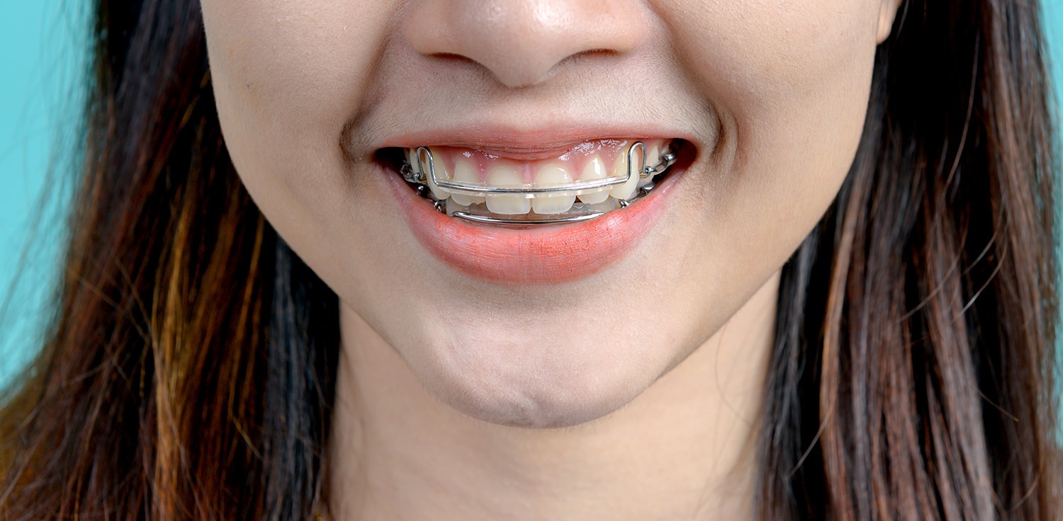Post Orthodontic Care